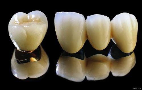 Đặc điểm 3 loại răng sứ kim loại PHỔ BIẾN nhất năm 2016