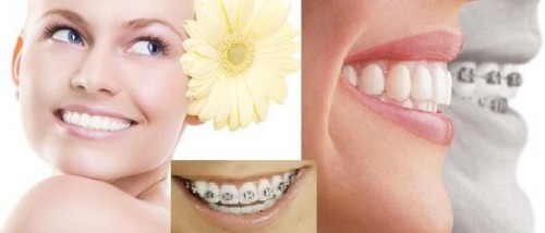 Cách làm răng bớt vổ bằng niềng răng thường mất nhiều thời gian