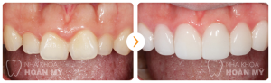 Mài răng có ảnh hưởng đến cấu trúc răng hay không?
