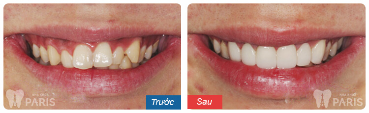 chỉnh một răng cửa bị vênh 6