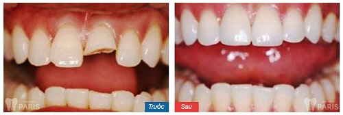 Sứt răng cửa làm thế nào? Phương pháp phục hình răng bền đẹp 4