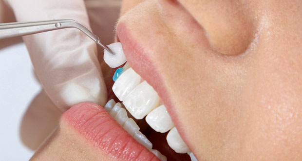 Cách nào điều trị mòn men răng hiệu quả nhất? 1
