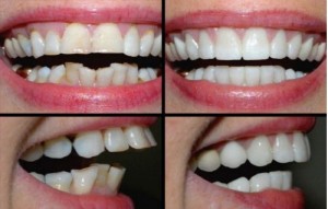 Giải pháp nào khắc phục răng sứ bị lung lay? 2