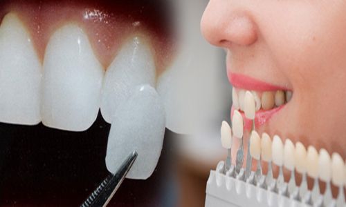 Nên lựa chọn tẩy trắng hay bọc răng sứ cho răng xỉn màu nặng? 2 Nên lựa chọn tẩy trắng hay bọc răng sứ cho răng xỉn màu nặng? 2