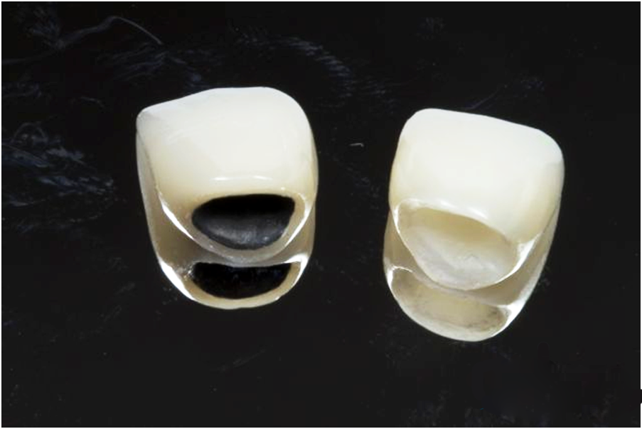 Địa chỉ nào bọc răng sứ giá rẻ nhất tại Hà Nội? 1