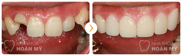 Bọc răng sứ Cercon có bị đau nướu hay không?【BS Tư Vấn】2