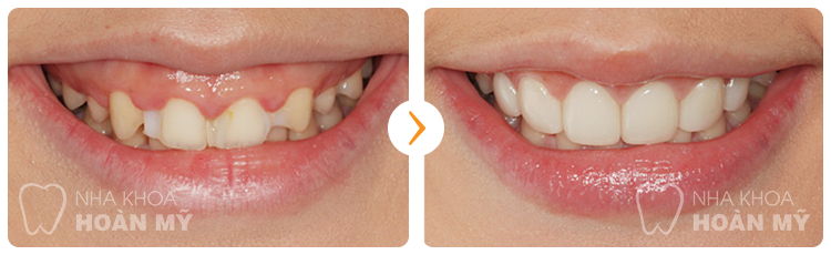 Bọc răng sứ alumina có đạt hiệu quả cao hay không?