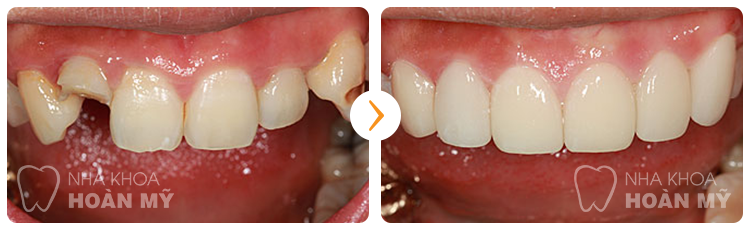 Có nên chụp răng sứ cho răng bị vỡ lớn không?