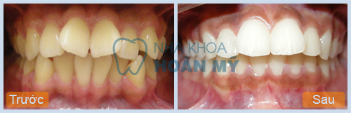 Bọc răng sứ - cách khắc phục răng bị lệch hiệu quả nhất Bọc răng sứ - cách khắc phục răng bị lệch hiệu quả nhất 1