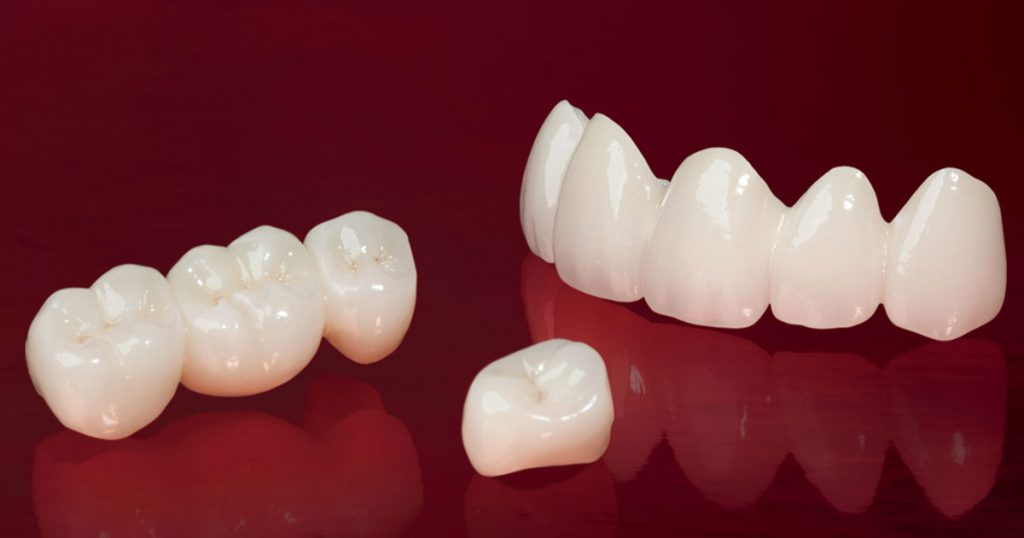 Cách làm trắng răng sứ Đơn Giản Hiệu Quả nhất cùng chuyên gia 3