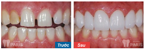 Khắc phục hai răng cửa bị hở bằng cách nào là tốt nhất? Khắc phục hai răng cửa bị hở bằng cách nào là tốt nhất? 2