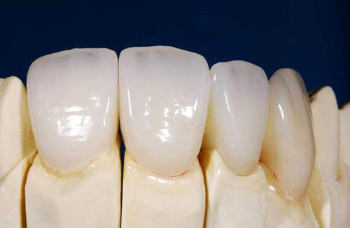 Bọc răng sứ toàn hàm diễn ra qua các bước nào? Bọc răng sứ toàn hàm diễn ra qua các bước nào?