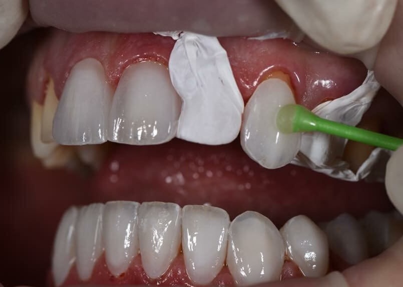 Bọc răng sứ chỉnh hô có hiệu quả không? 1
