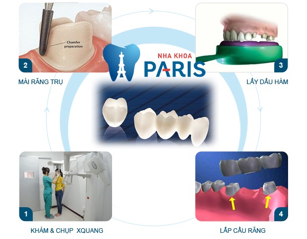 Làm cầu răng như thế nào là đúng kỹ thuật? Làm cầu răng như thế nào là đúng kỹ thuật?