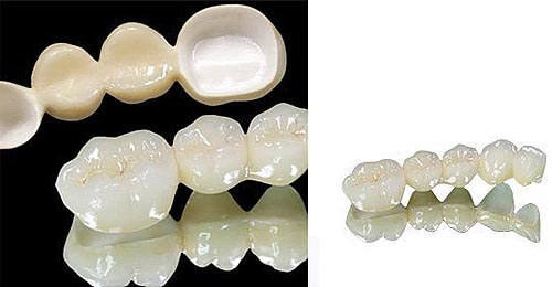  Ưu điểm CN bọc răng sứ Titan cho hàm răng trắng sáng đẹp tự nhiên 3