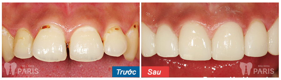 Bọc răng sứ cercon bằng công nghệ CT5 chiều-Sự kết hợp HOÀN HẢO 3