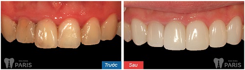 Bọc răng sứ bị viêm lợi: Nguyên nhân và cách khắc phục HIỆU QUẢ 2