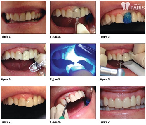 5 Tiêu chí đánh giá địa chỉ làm răng Direct Veneer ở đâu tốt? 6