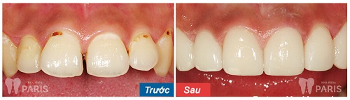 Răng cửa bị lệch 5