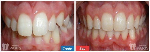 Bọc răng sứ cercon bằng công nghệ CT5 chiều-Sự kết hợp HOÀN HẢO 4