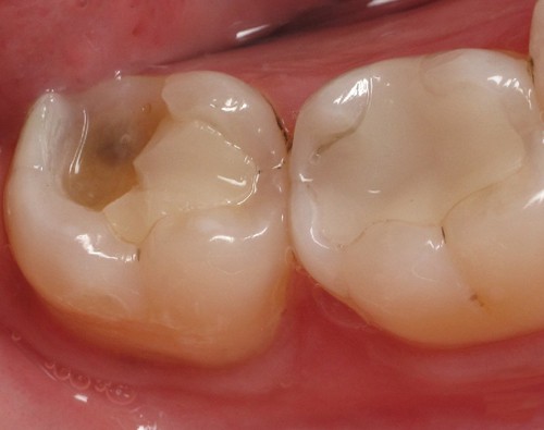 Sứt răng hàm có ảnh hưởng như thế nào? Cách khắc phục Triệt Để 1