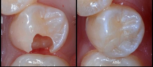 Sứt răng hàm có ảnh hưởng như thế nào? Cách khắc phục Triệt Để 2