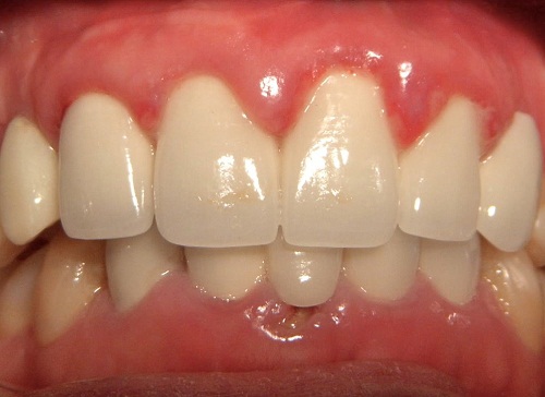 Bọc răng sứ bị viêm lợi 1 