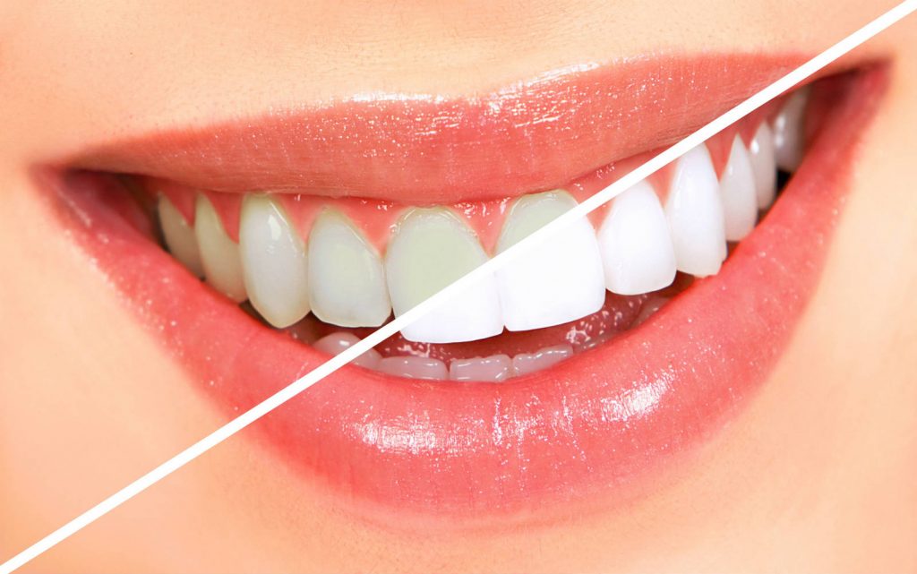 Cách làm trắng răng sứ Đơn Giản Hiệu Quả nhất cùng chuyên gia 1