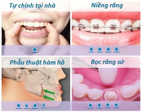 3 dạng răng hô và 4 cách làm răng hết hô phổ biến nhất hiện nay 3 dạng răng hô và 4 cách làm răng hết hô phổ biến nhất hiện nay 4