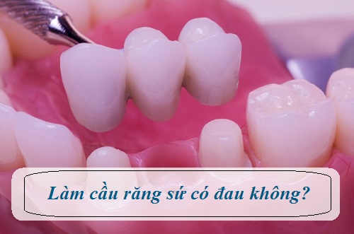 Làm cầu răng sứ có đau không? Chuyên gia nha khoa giải đáp 1