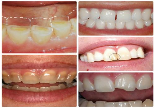 Những trường hợp nào nên làm mặt dán sứ Veneer? BS Tư Vấn 2