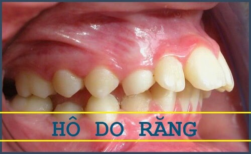 Cách làm răng hết hô hiệu quả nhất được nhiều người áp dụng Cách làm răng hết hô hiệu quả nhất được nhiều người áp dụng
