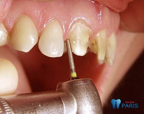 Bọc răng sứ có thể bị viêm lợi nếu nha sĩ thực hiện sai kỹ thuật mài răng