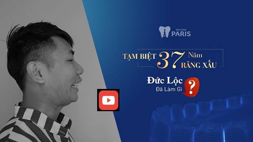 Có nên bọc sư cho răng cửa bị mọc lệch