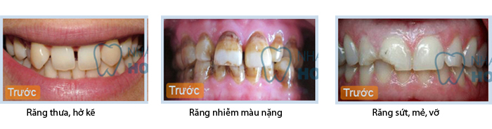 Bọc răng toàn sứ CT 5 chiều phục hồi răng thẩm mỹ