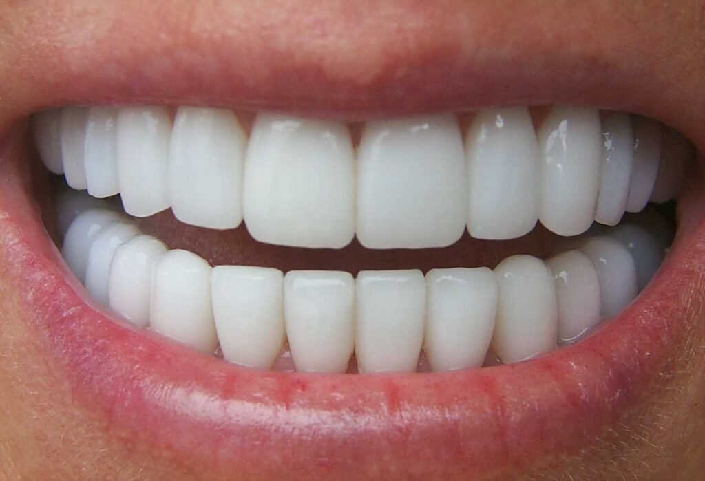 Cách chỉnh răng hô siêu nhanh đảm bảo HIỆU QUẢ sau 1 tuần điều trị