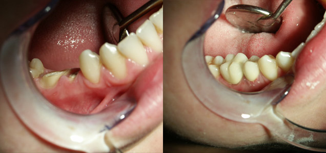 Bọc răng sứ Cercon cho răng hàm bị sâu có tốt không?