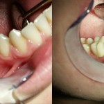 Có thể bọc răng sứ sau khi lấy tủy không? Thời điểm nào là tốt nhất?