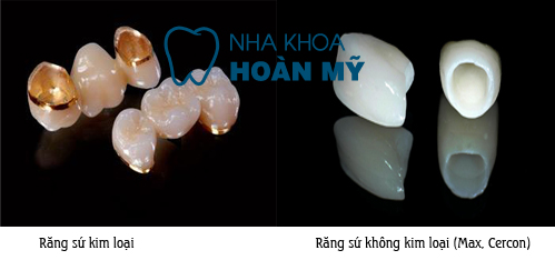 Mức giá bọc răng sứ E.Max tại Nha khoa Paris là bao nhiêu?