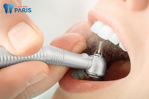 Bọc răng sứ cho răng cửa bị sứt - Giải pháp phục hình răng khiếm khuyết hoàn hảo