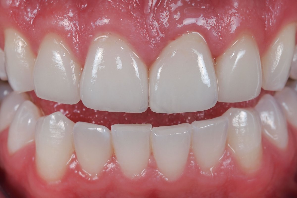 Nguyên nhân của tình trạng răng sứ đổi màu sau khi phục hình 2