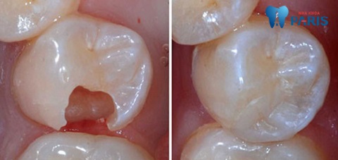 Bọc răng sứ cho răng hàm bị vỡ duy trì độ bền lâu dài, lên tới 20 năm
