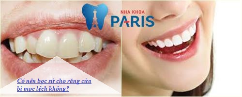 Có nên bọc sứ cho răng cửa bị mọc lệch hay không?