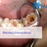 Răng cấm bị vỡ lớn phải làm sao để khắc phục dứt điểm ?