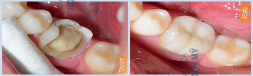 Giá trồng răng bị vỡ bao nhiêu tiền là rẻ nhất?