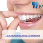 Có cách làm răng đều không cần niềng nào không – Giải đáp từ bác sỹ
