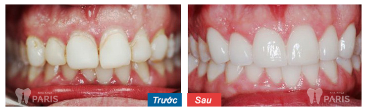 Hồng Trang: Răng tôi bị sâu nặng, hỏng cả hàm trên. Nhưng nhờ bọc sứ tại nha khoa Paris mà giờ tôi ăn nhai tốt rồi và cũng đẹp hơn. Cảm ơn bác sỹ.