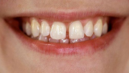 “Mách nhỏ” những trường hợp nên làm lại răng cửa giả