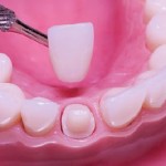 Bạn đang lo lắng bọc răng có ảnh hưởng gì không?