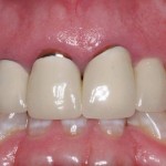 Tìm hiểu “sự thật” bọc răng sứ có nguy hiểm không?